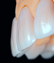 Veneers without grinding